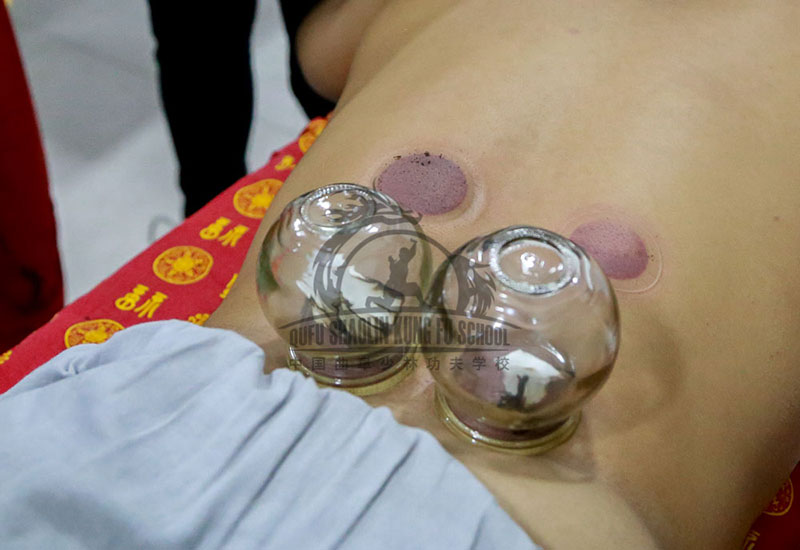 Practicing Cupping therapy