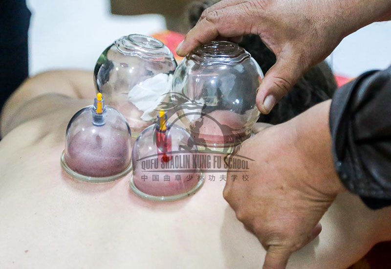 Practicing Cupping therapy 1