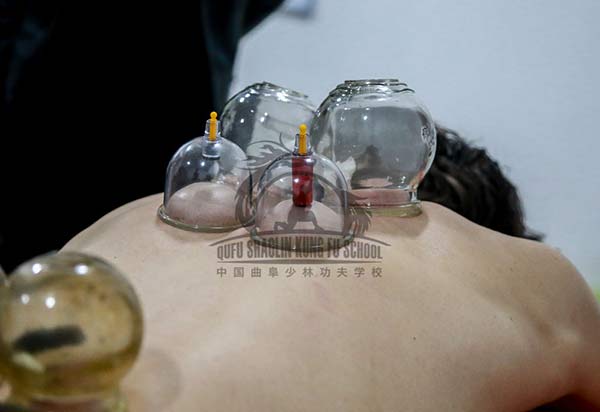 Firing Cupping of TCM